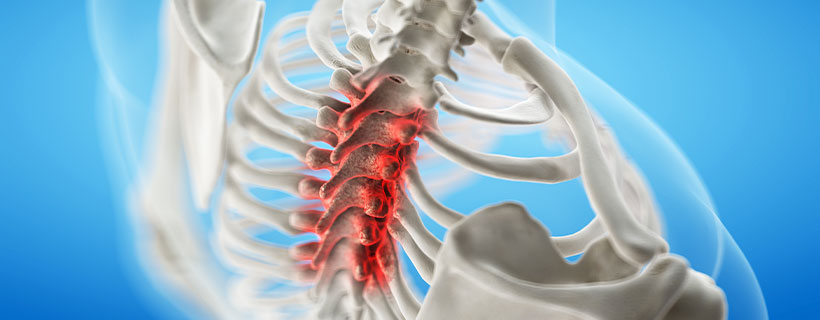 patient needing Spinal Stenosis relief in Richardson TX
