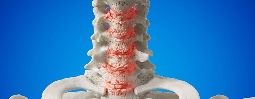 patient needing Spondylosis relief in Richardson TX